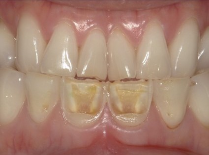 根管治療のイラスト