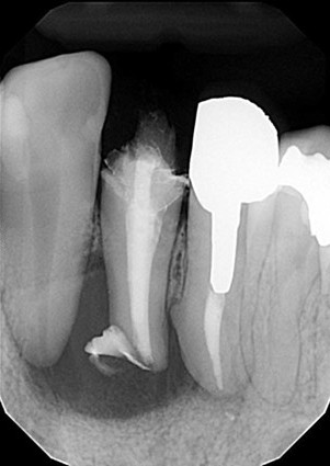 根管治療のイラスト