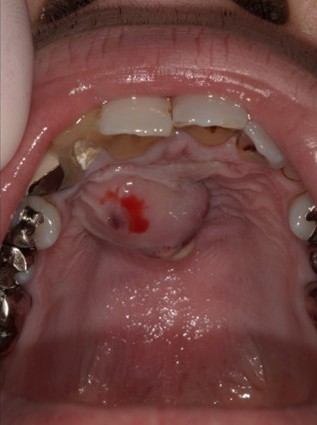 根管治療のイラスト