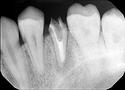 根管治療のイラスト