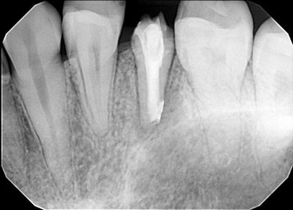 根管治療のイラスト