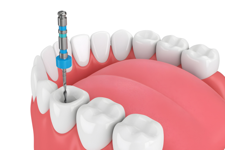 根管治療のイメージ