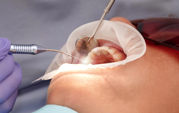 ストリークレーザー治療の様子