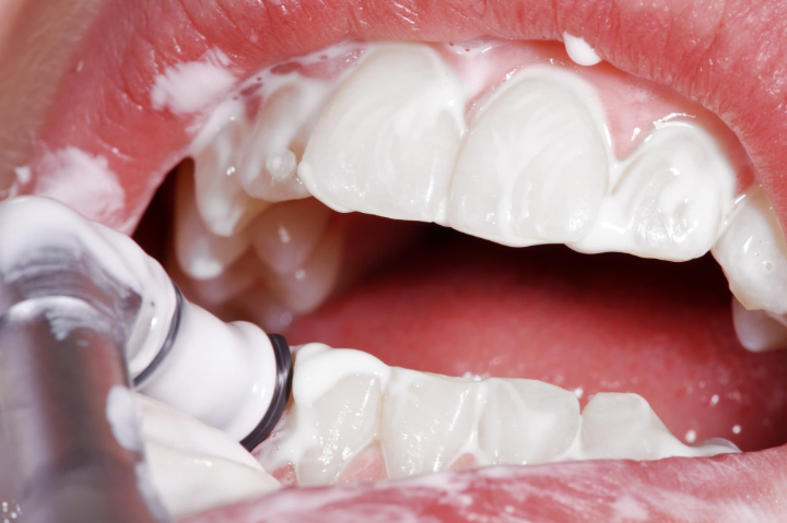 ホワイトニング後に虫歯になるのを防ぐために歯科医院でクリーニングを受けるイメージ