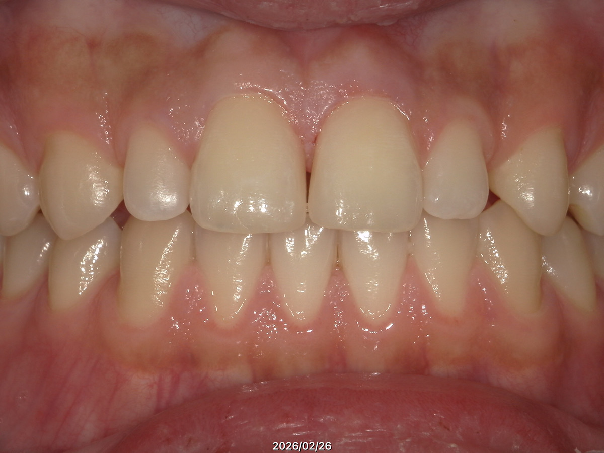 前歯ダイレクトボンドAfter