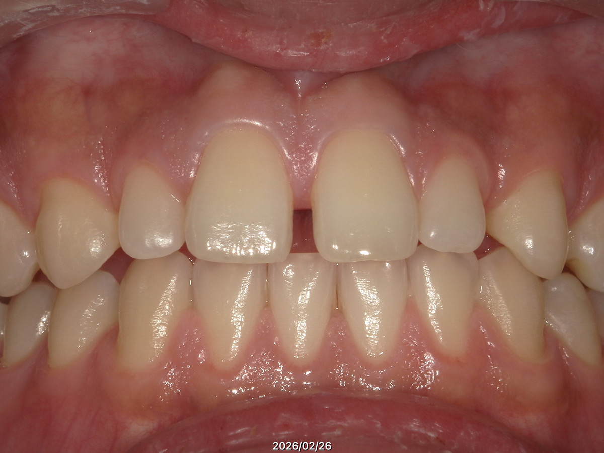 前歯ダイレクトボンドBefore class=