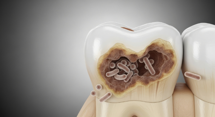 歯の内部が腐食した様子