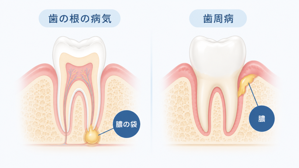 歯茎に膿が溜まる原因