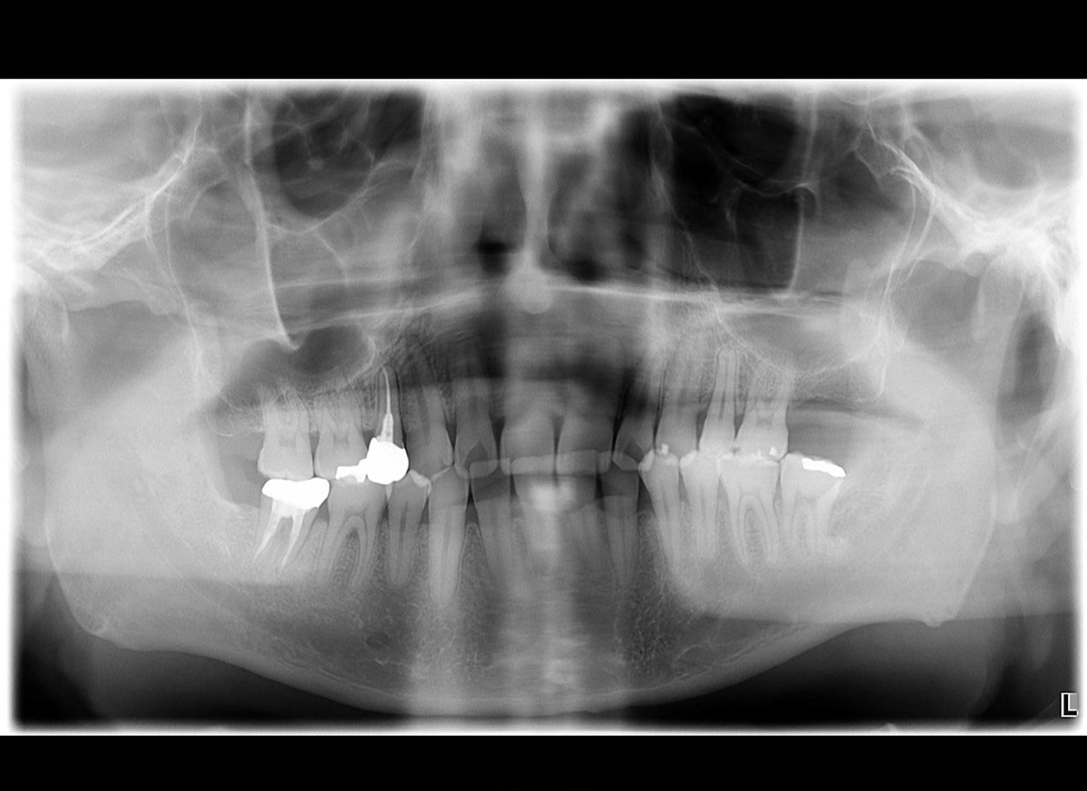 治療後に骨の再生を確認したパノラマX線写真