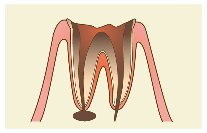 歯根治療・歯の根の治療・根管治療