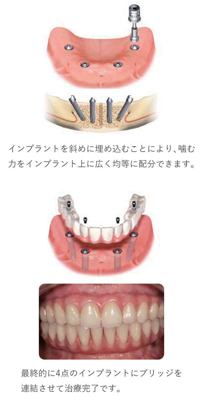 All-on-4の仕組み