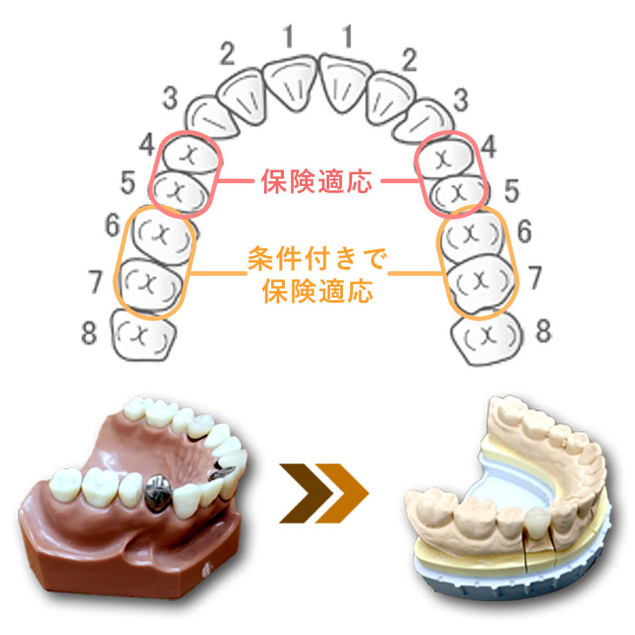 健康保険で「白い歯」に
