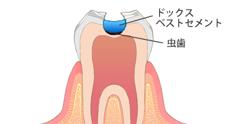 ステップ：2