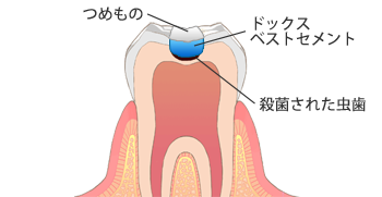ステップ：3