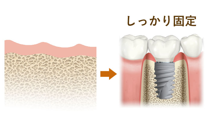 ＜ケース１＞　そもそも歯がない！
