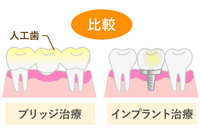 ＜ケース２＞　他の歯も大切！