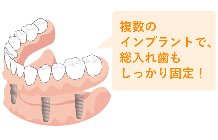 ＜ケース３＞　入れ歯が不満！