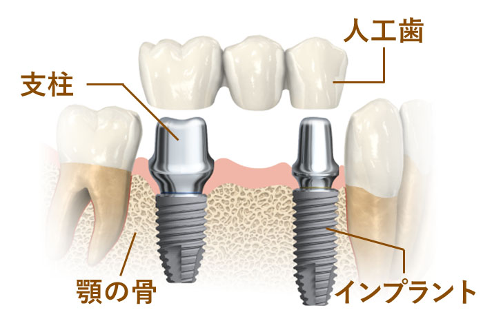 自分の歯を残す当院の3つのメソッド