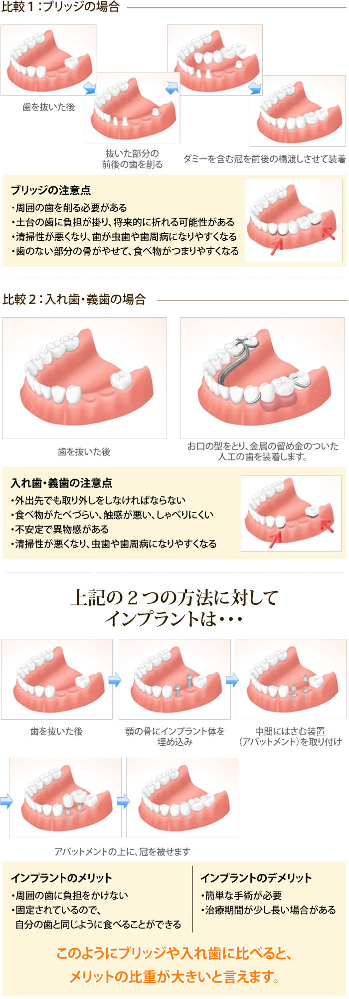 インプラント治療法と従来の治療法との比較