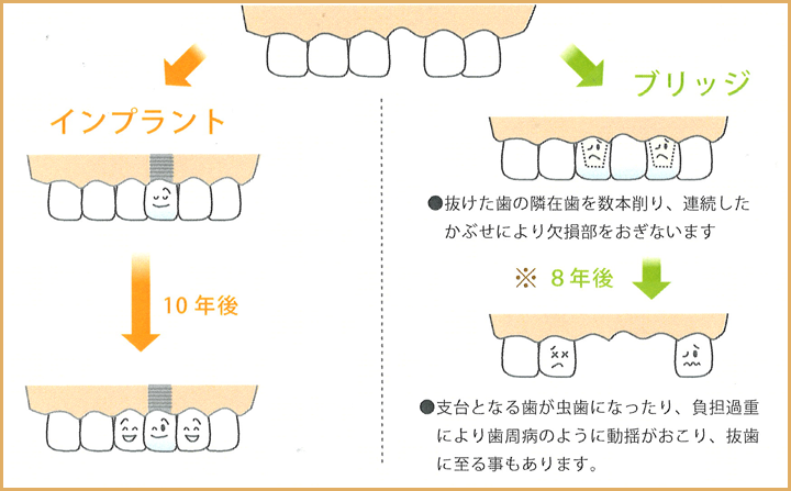 ブリッジ治療の場合、支台となる歯が虫歯になったり、負担過重により歯周病のように動揺がおこり、抜歯に至ることもあります。