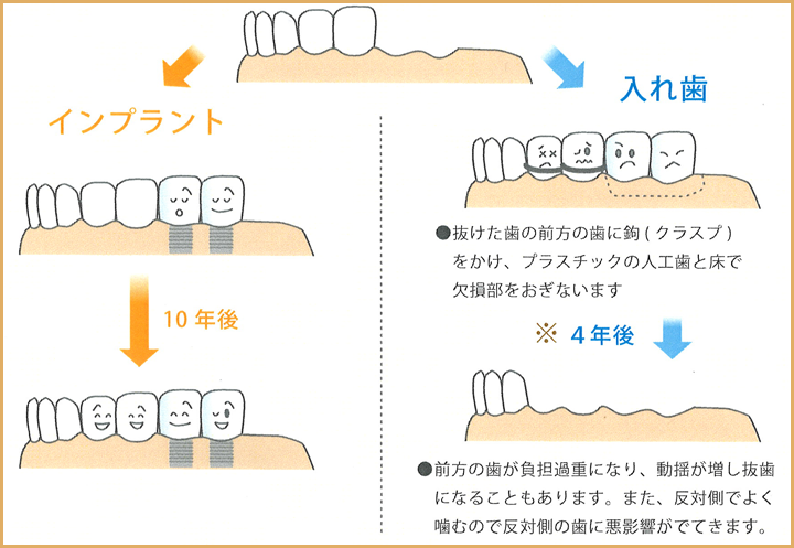 入れ歯の場合、前方の歯が負担過重になり、動揺が増し抜歯になることもあります。また、反対側でよく噛むので反対側の歯に悪影響がでてきます。