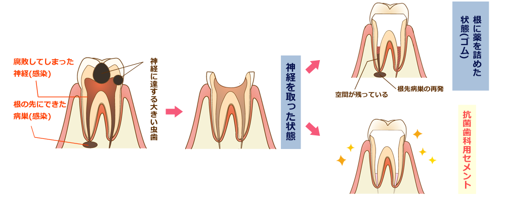抗菌性歯内療法