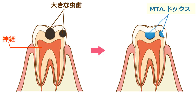 MTAセメント、ドックスセメント