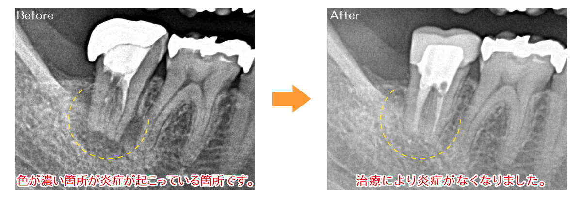 根幹治療症例