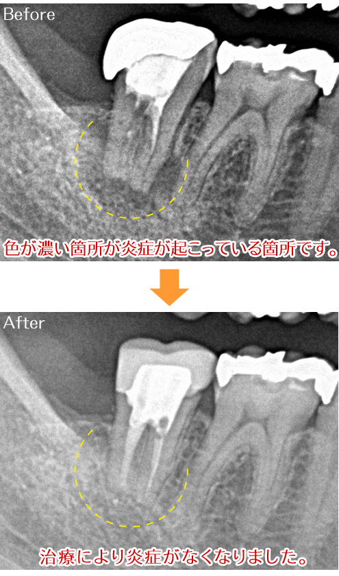 根幹治療症例