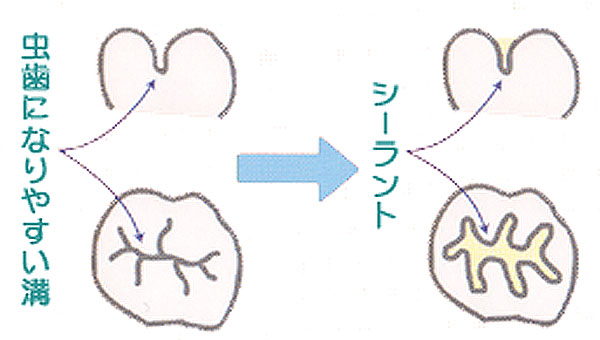 シーラント解説図