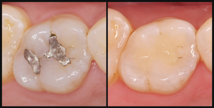 銀歯の詰め物を白くしたイメージ